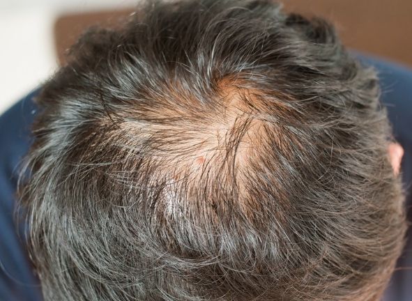 禿頭預防 禿頭預防