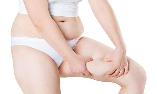 內側脂肪堆積 內側脂肪堆積