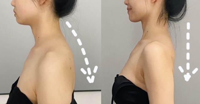 背部變厚改善 背部變厚改善