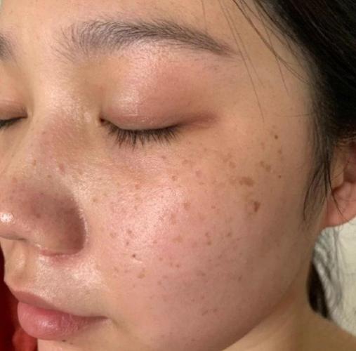 黑斑成因 黑斑成因