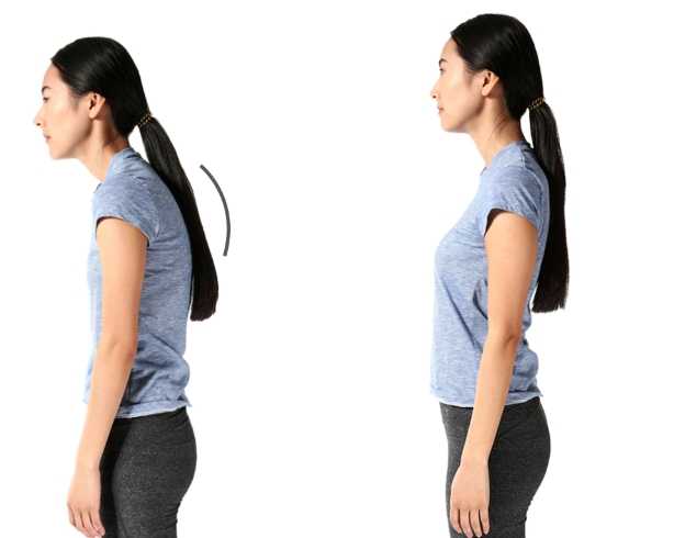 駝背矯正 駝背矯正