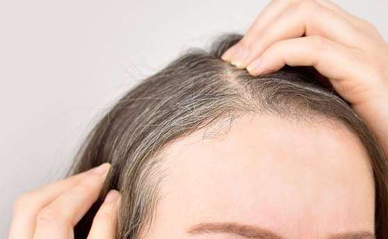 早生白髮治療 早生白髮治療