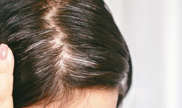 掉髮治療方法 掉髮治療方法