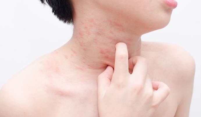 戒菸皮膚過敏 戒菸皮膚過敏