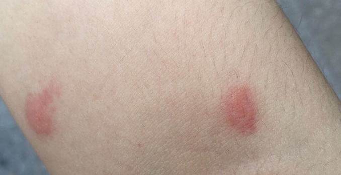 丘疹性蕁麻疹症狀原因