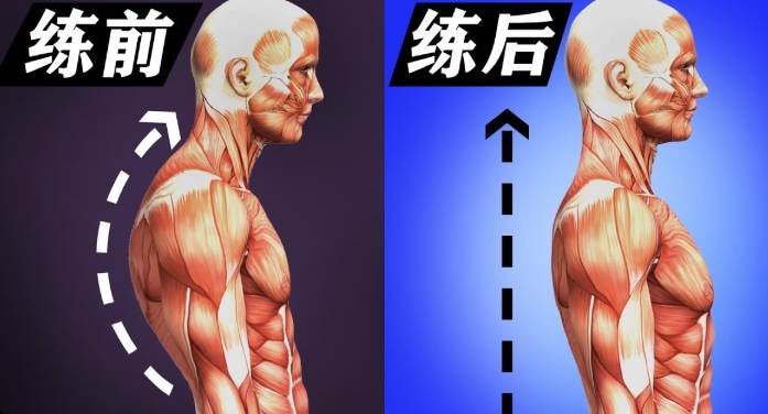 駝背矯正 駝背矯正