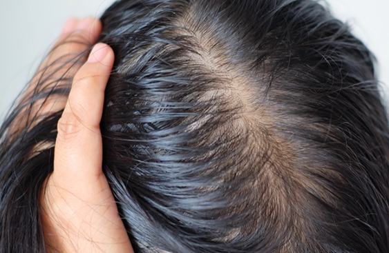 頭髮變細原因 頭髮變細原因