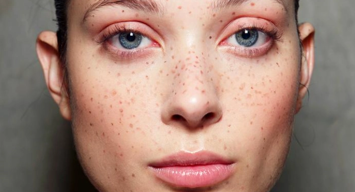 如何去斑和黑色素