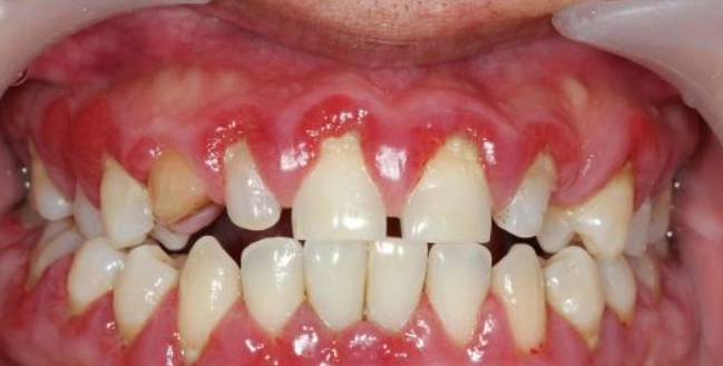 如何避免牙齦萎縮