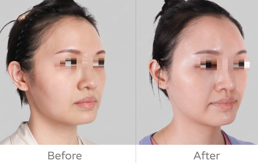 減少臉部脂肪方法