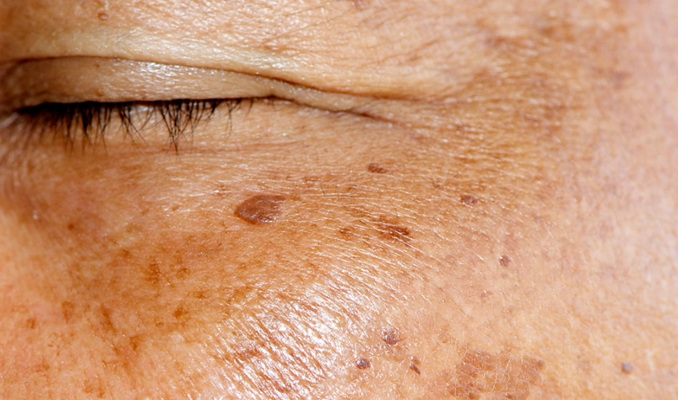 色斑如何去除？2023最有效的淡斑方法全攻略