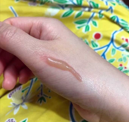 油刺原因與治療