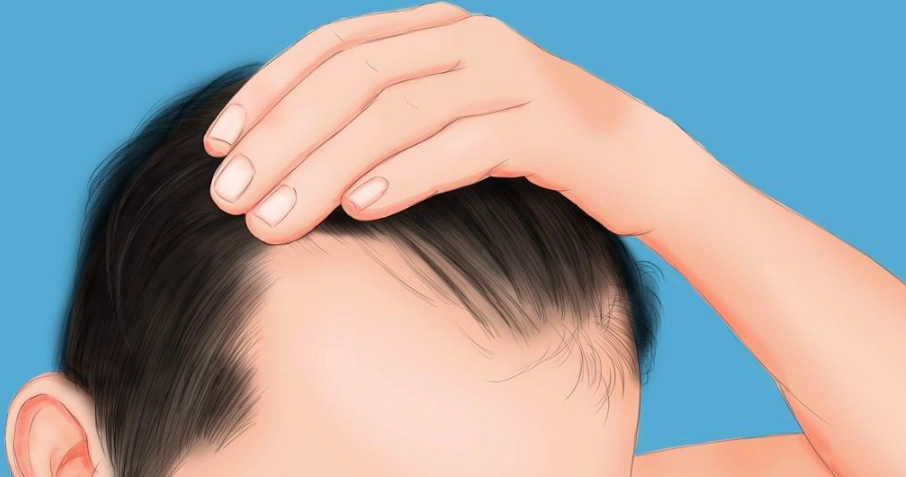 男性秃头早期症状