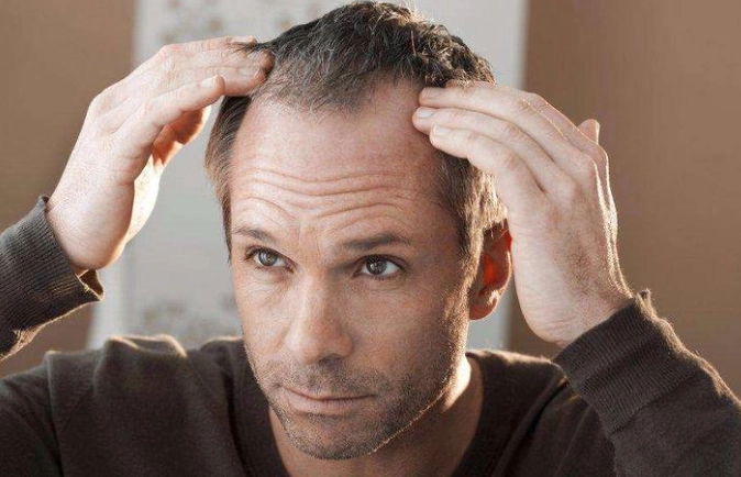 男性掉髮年齡