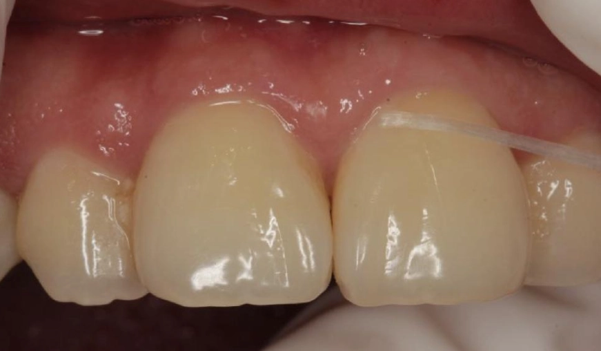 牙齦受傷處理 牙齦受傷處理