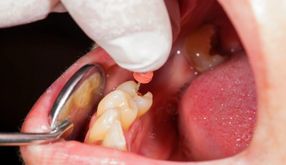 牙線正確使用方法 牙線正確使用方法