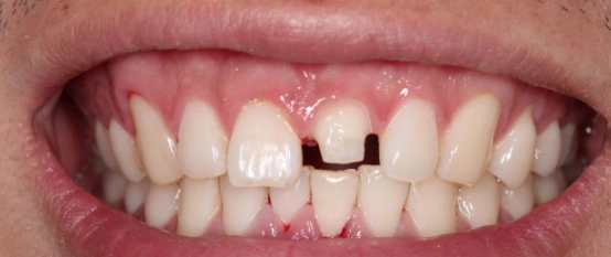 牙線正確使用方法 牙線正確使用方法