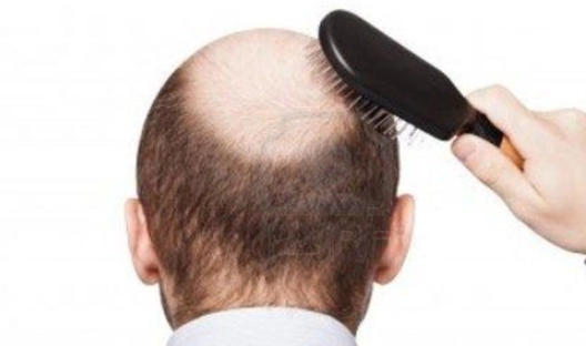 男生禿頭年齡