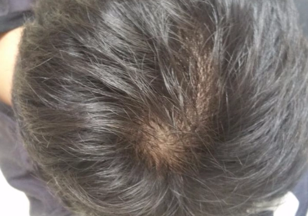 男性秃头早期症状