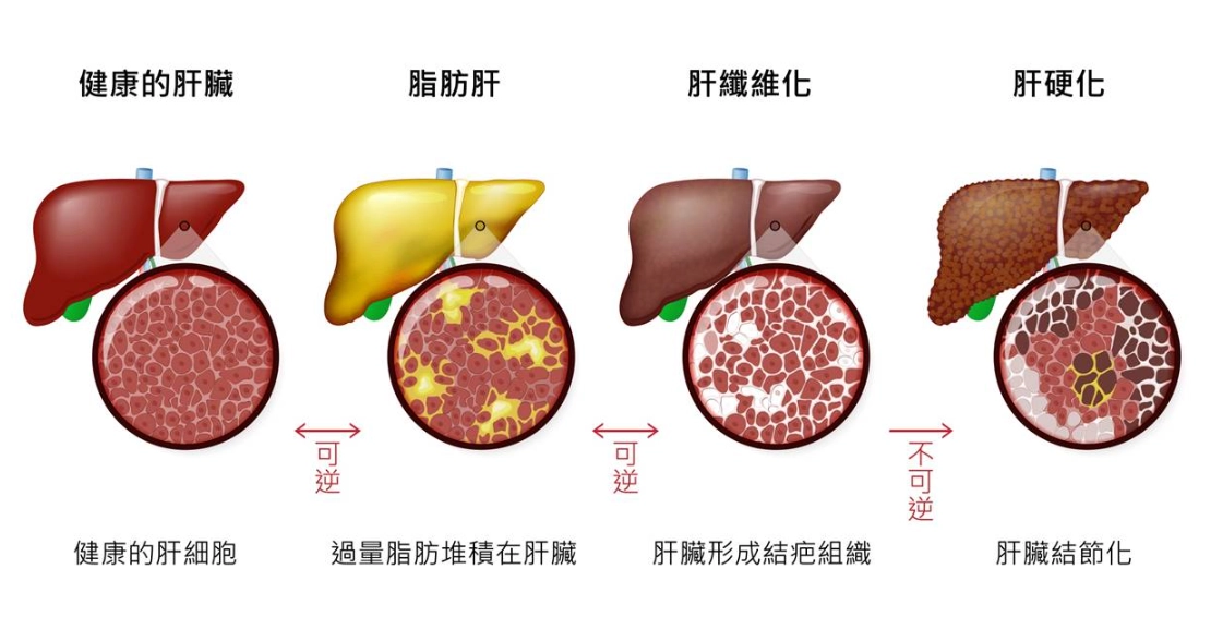 脂肪肝中醫治療 脂肪肝中醫治療