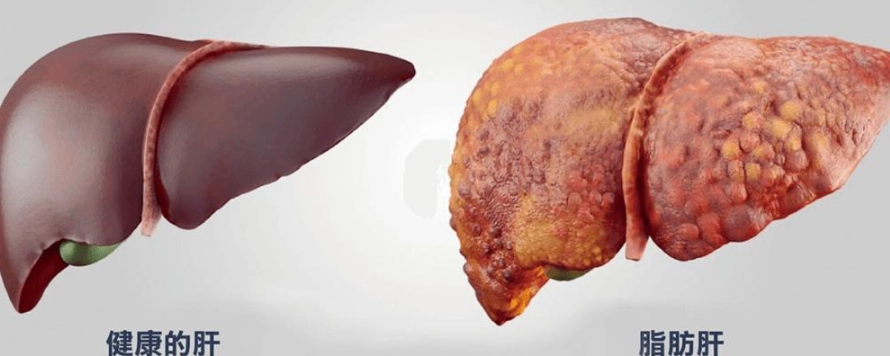 脂肪肝治療中藥