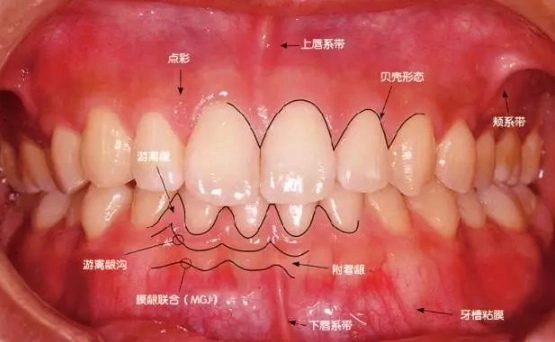 牙齦受傷處理 牙齦受傷處理