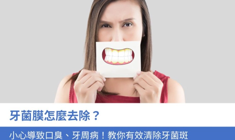 牙菌膜清除方法