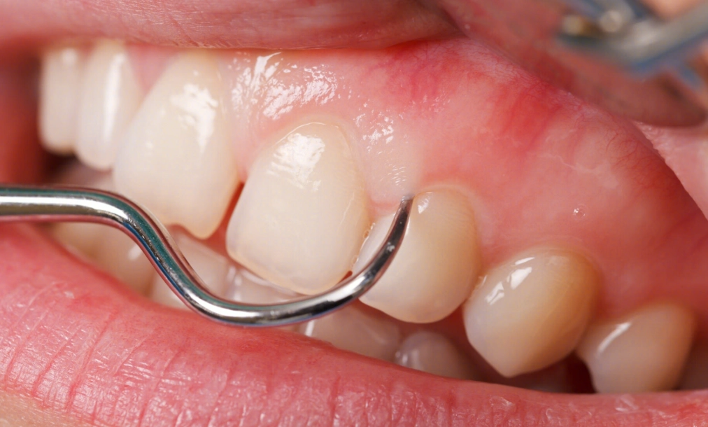 牙線正確使用方法 牙線正確使用方法