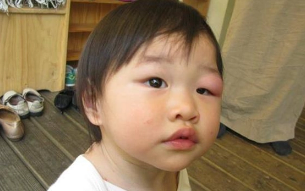 幼兒眼睛被蚊子叮