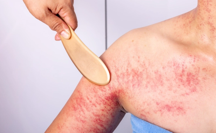 刮痧皮膚過敏 刮痧皮膚過敏