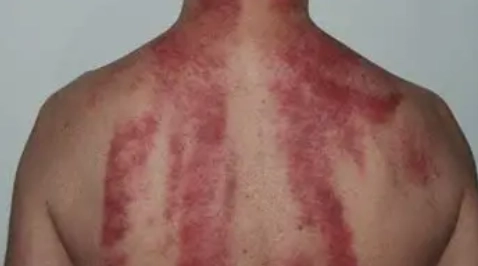 飲酒後刮痧安全嗎