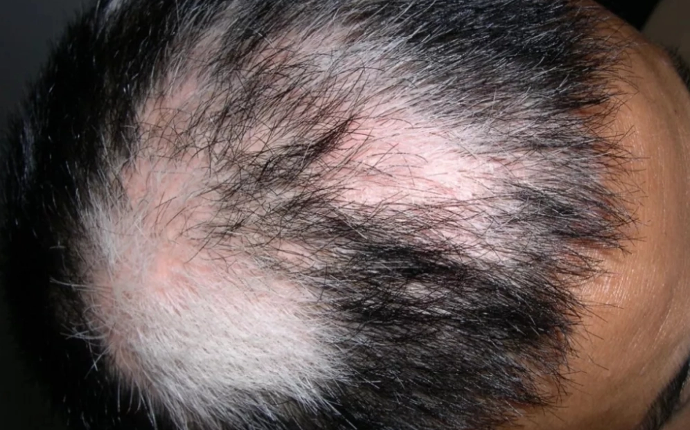 頭皮顏色很白怎麼辦？專業解析原因與改善方法全攻略