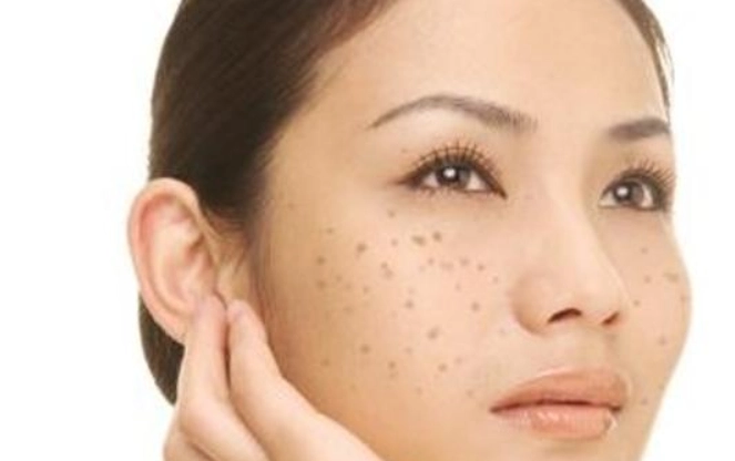 臉上黑斑原因