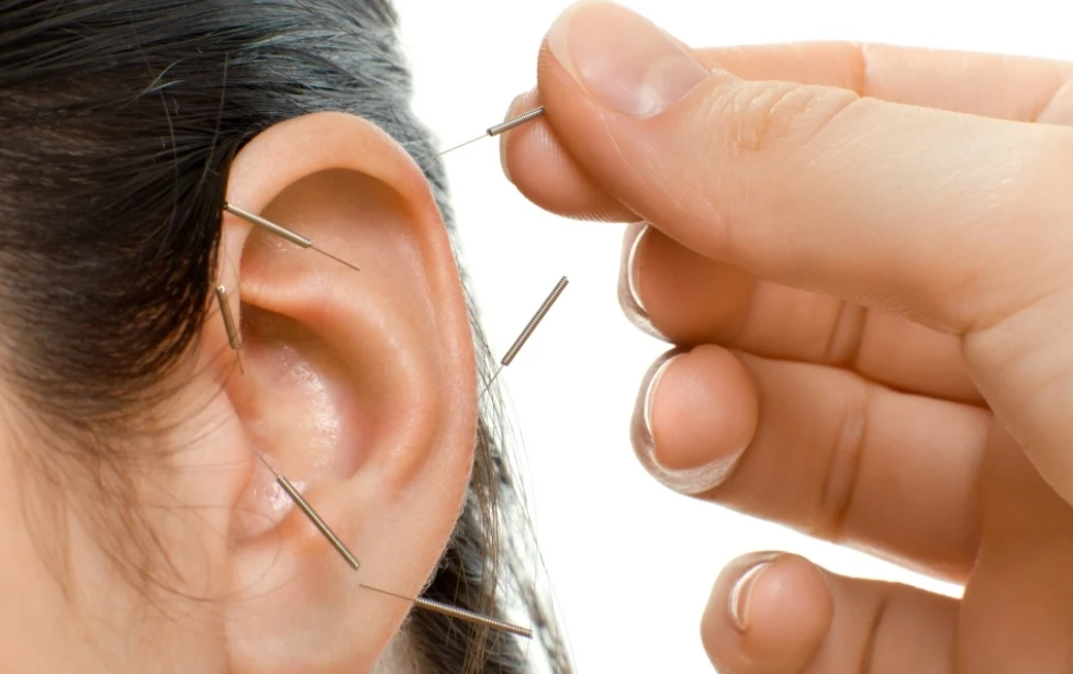 針灸耳鳴療程