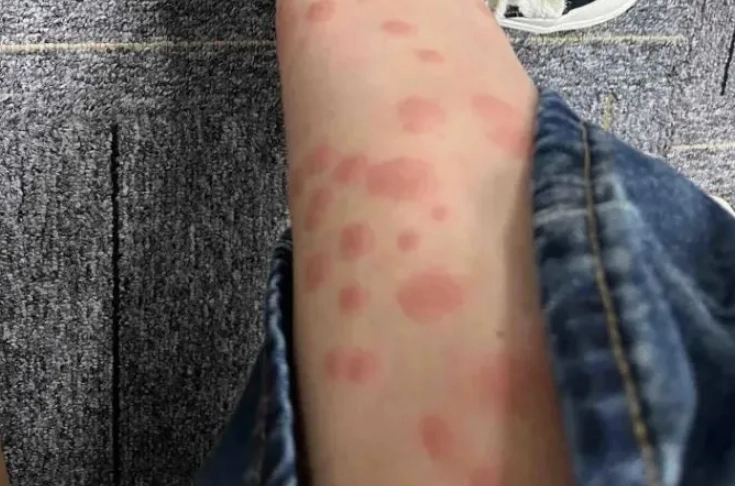 蚊子叮咬腫脹原因