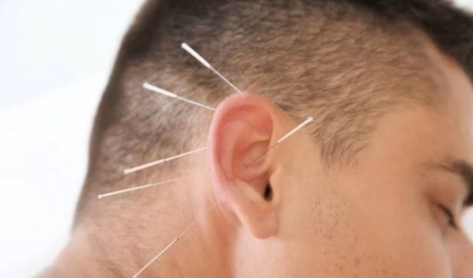 針灸耳鳴療程