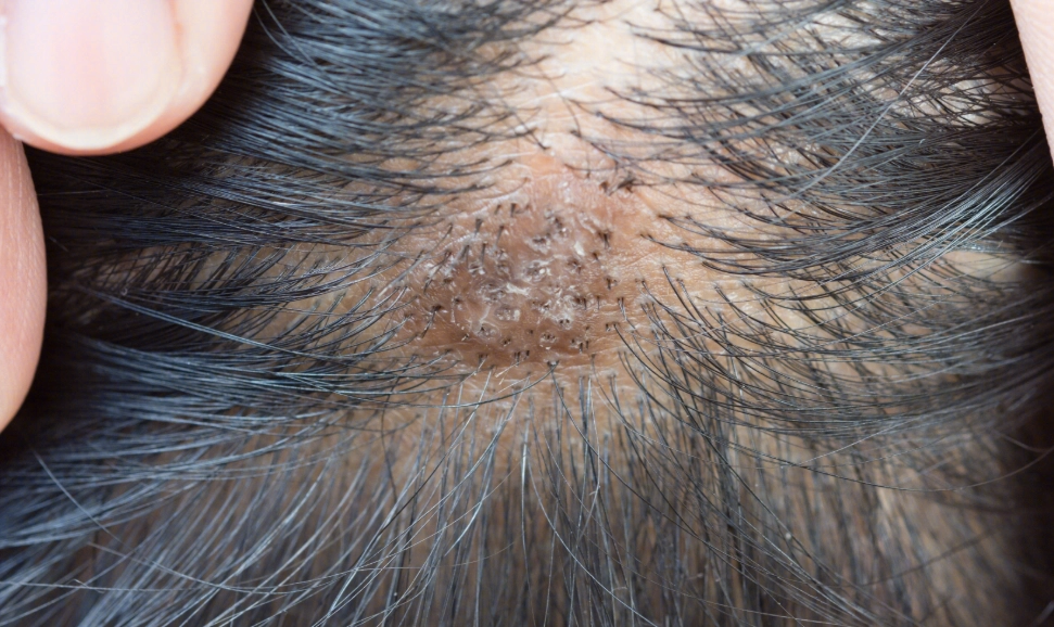 頭皮發紅不癢處理