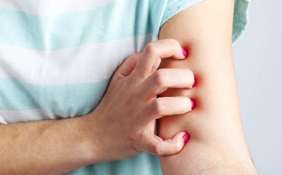 為什麼容易被蚊子叮