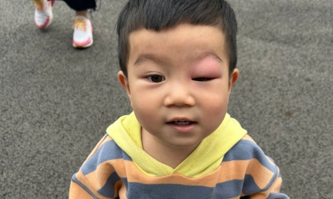嬰兒眼皮蚊蟲叮咬