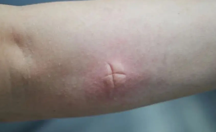 蚊子咬止癢妙招