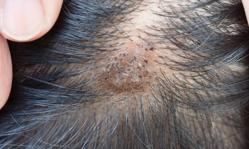 頭皮結痂原因