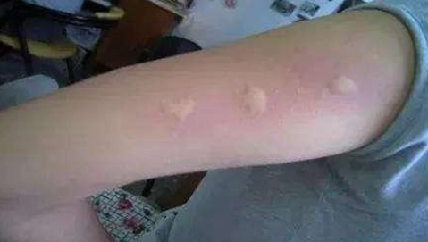 蚊子叮咬血型關係