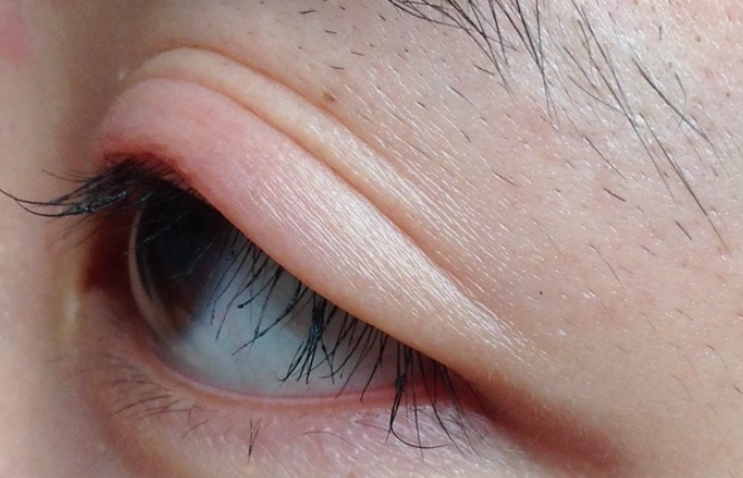 嬰兒眼睛叮咬腫脹