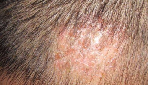 頭皮紅紅原因