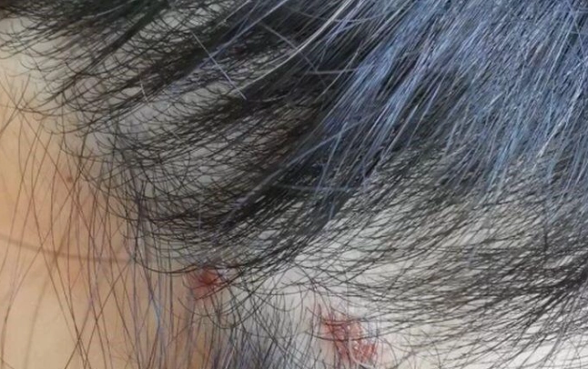 頭皮發紅不癢處理