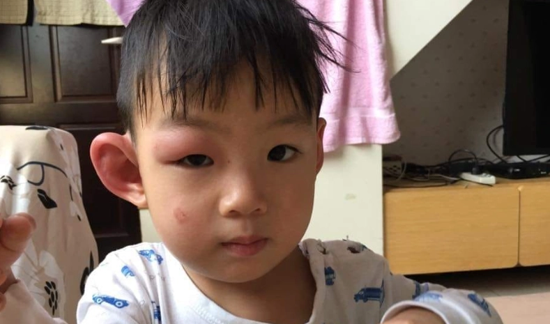 蚊子叮眼皮腫脹