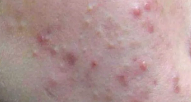 閉鎖性粉刺處理