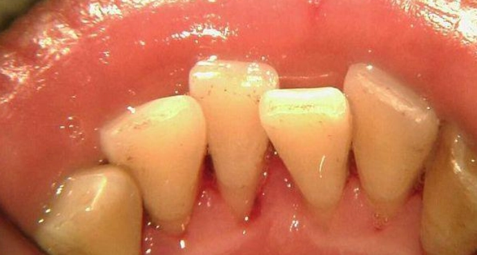 牙齦萎縮原因 牙齦萎縮原因