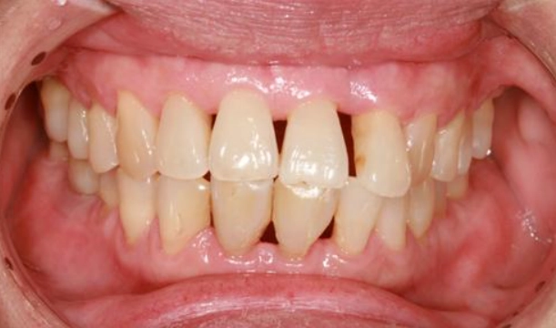 牙齦萎縮原因 牙齦萎縮原因