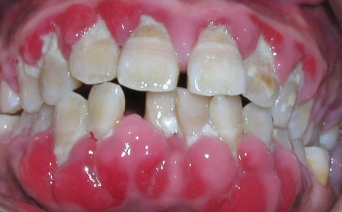 牙齦腫痛怎麼辦